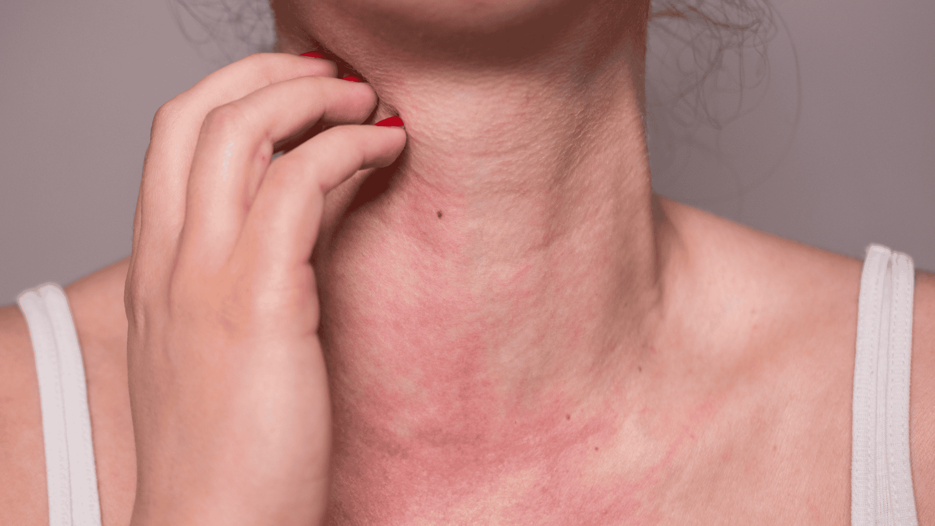 Allergy Testing in Richmond VA 3